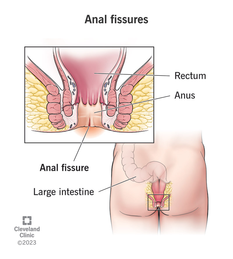 Anal Fissür görseli