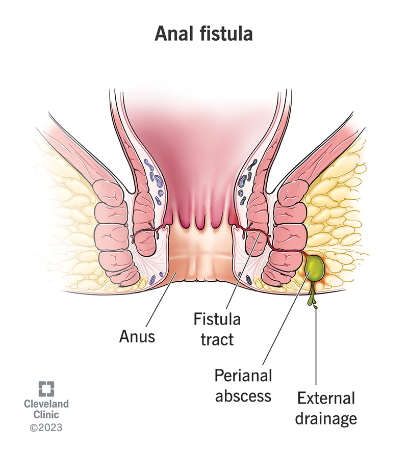 Anal Fistül görseli