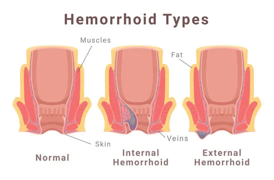 Hemoroid görseli