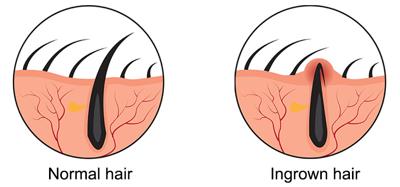 Kıl Dönmesi (Pilonidal Sinüs) görseli